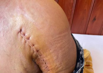 ស្ដ្រីតំណាងសហគមន៍ឧត្ដមស្រែពស់ទាមទារយុត្តិធម៌ករណីក្រុមទាហានវាយបាក់ដៃខាងឆ្វេង