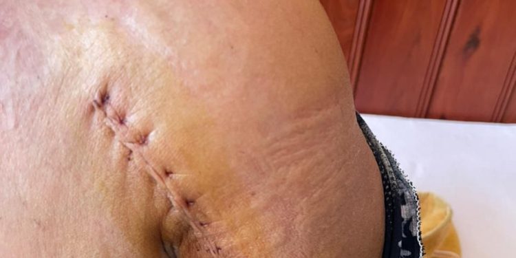 ស្ដ្រីតំណាងសហគមន៍ឧត្ដមស្រែពស់ទាមទារយុត្តិធម៌ករណីក្រុមទាហានវាយបាក់ដៃខាងឆ្វេង