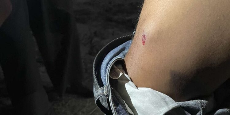 ភ្លៅខាងស្ដាំរបស់លោក ឡុង ប៊ុនណារា រងរបួសដោយសារគ្រាប់កាំភ្លើងខ្យល់ឬកាំភ្លើងកែច្នៃ ក្រុមសន្តិសុខរបស់លោកឧកញ៉ា រតនៈ សម្បត្តិ នៅយប់ថ្ងៃទី១៥ ខែធ្នូ ឆ្នាំ២០២៤។ (រូបភាពផ្ដល់ឱ្យ)